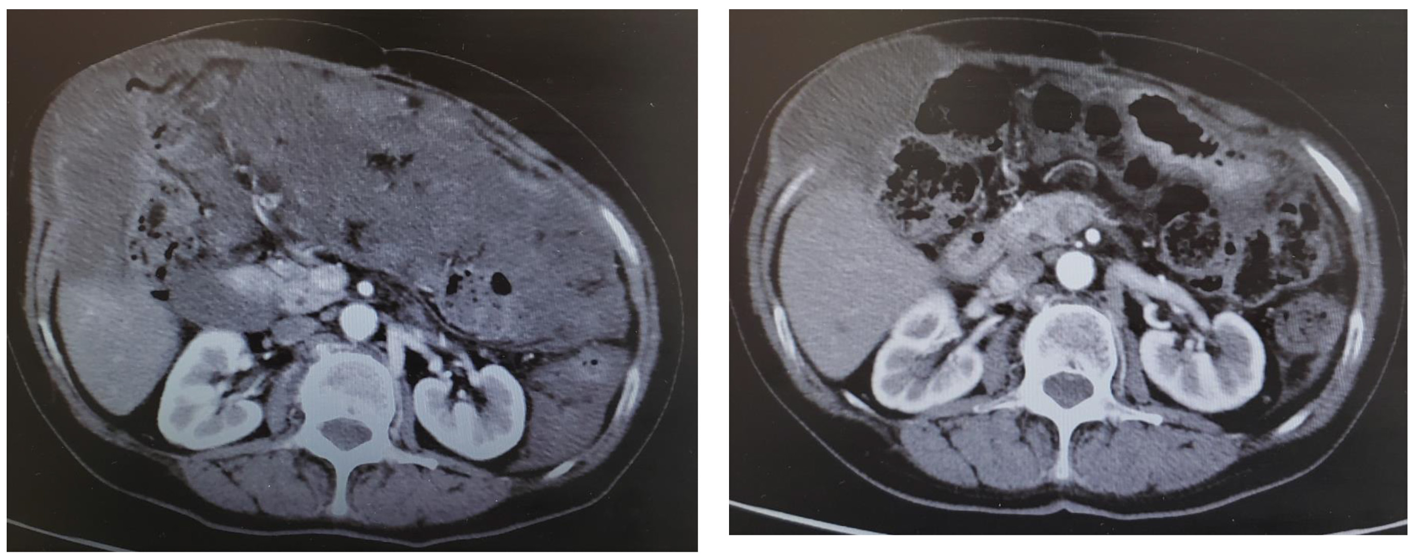 Peritoneal Mesothelioma