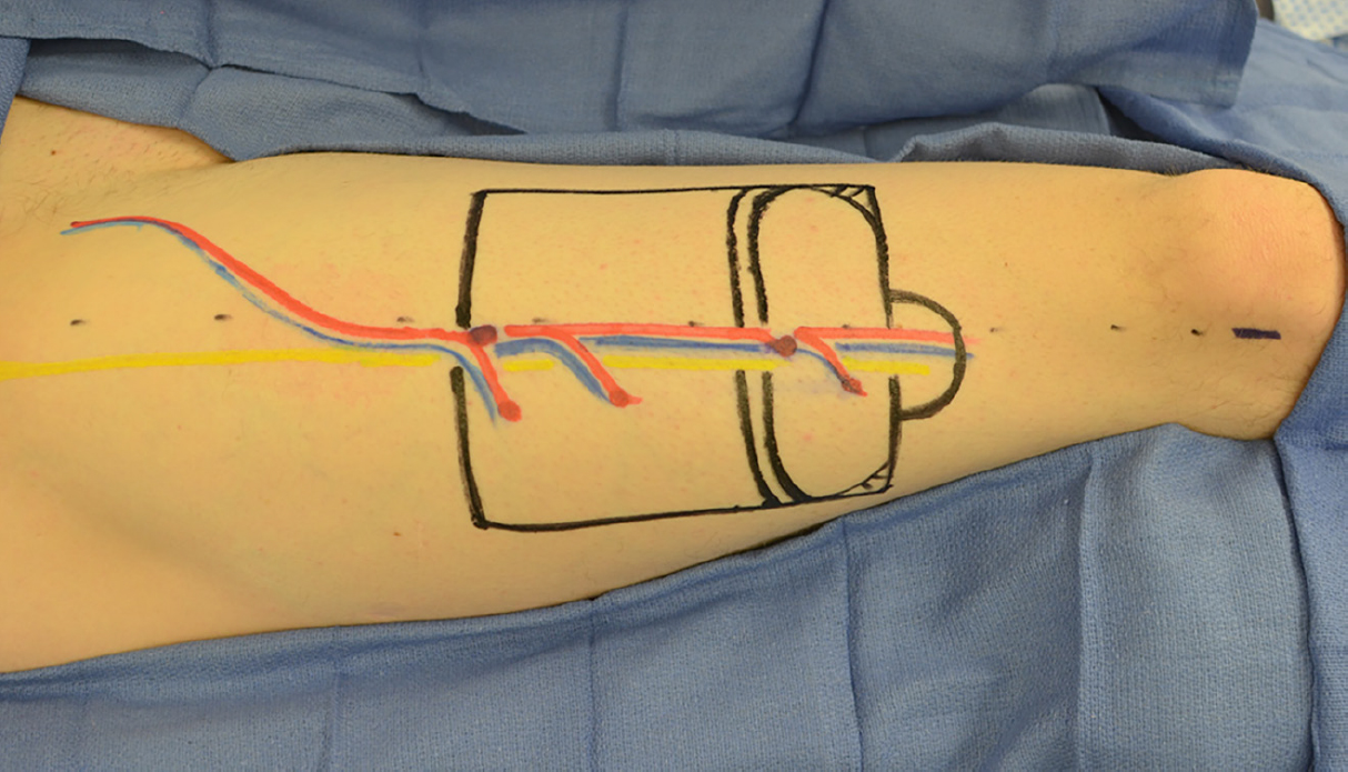 Conventional Surgical Techniques And Emerging Transplantation In