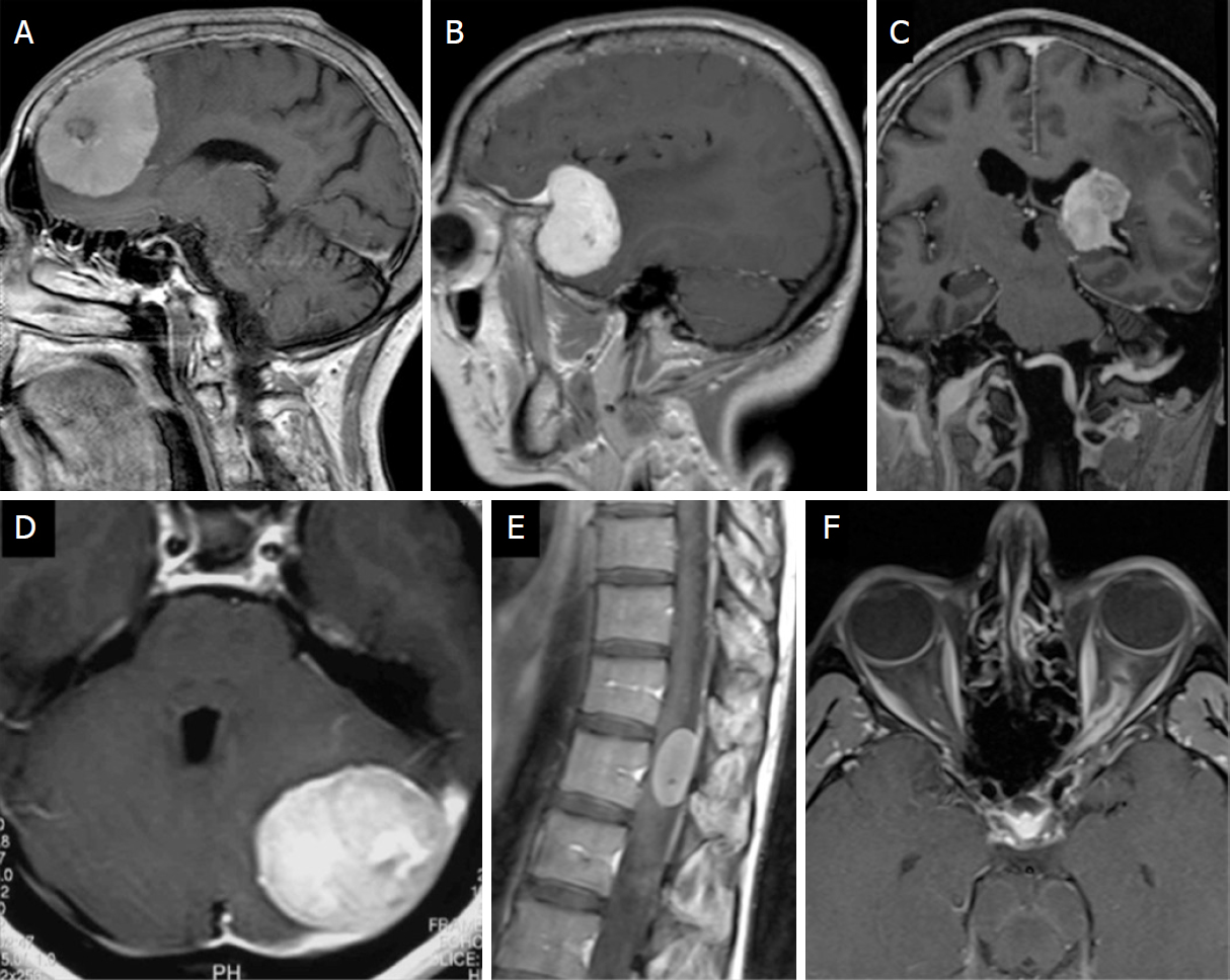 Neuroimaging In Meningiomas Old Tips And New Tricks