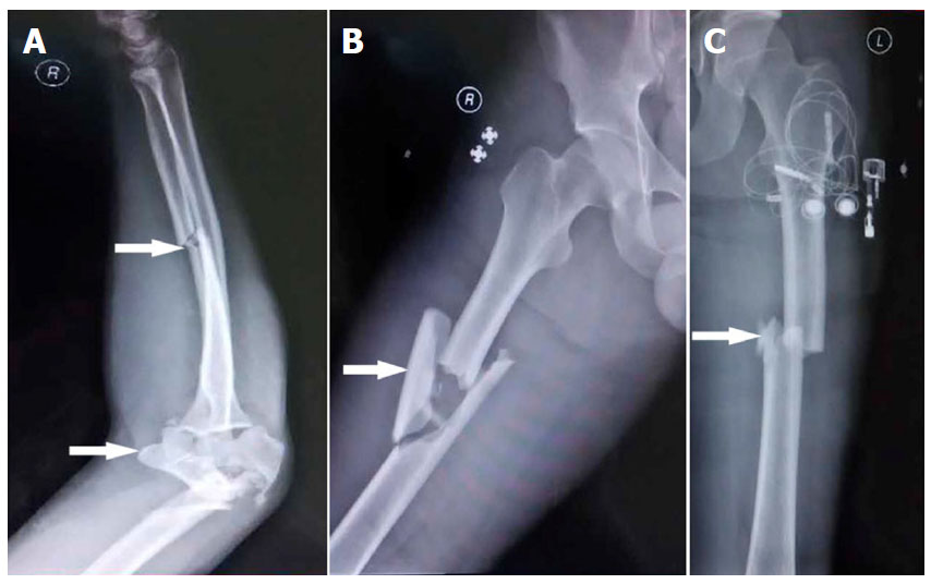 Cerebral Fat Embolism Syndrome After Long Bone Fracture Due To Traffic Accident A Case Report