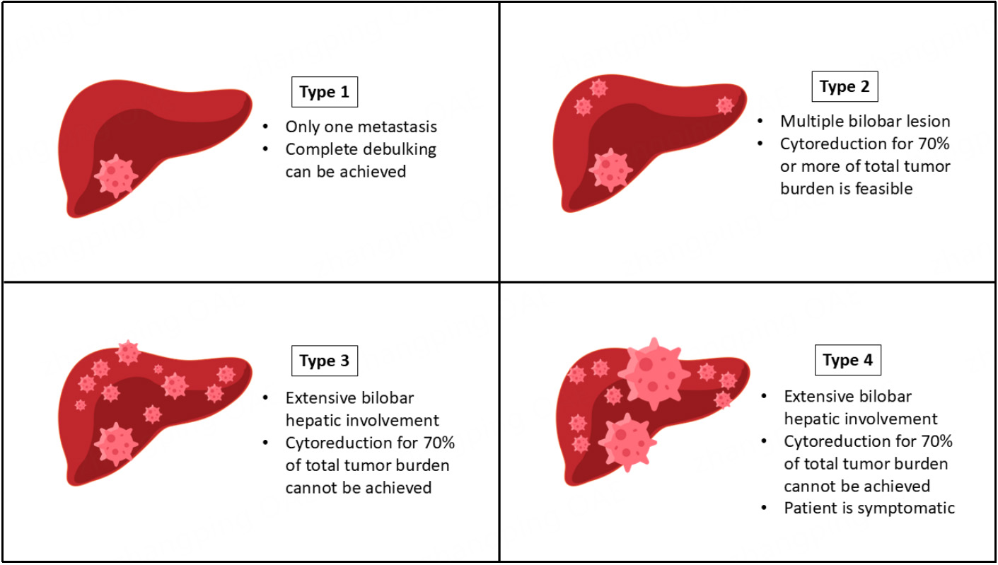 Updates on the management of neuroendocrine liver metastasis
