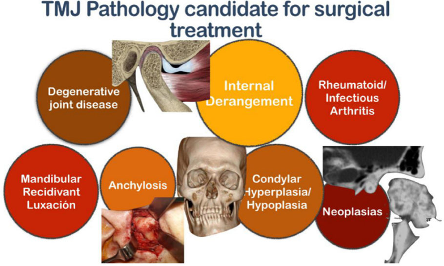 scientific-evidence-in-surgery-for-the-treatment-of-temporomandibular