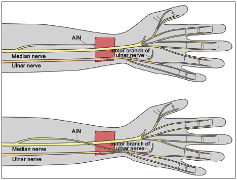 Nerve transfers of the forearm and hand: a review of current indications