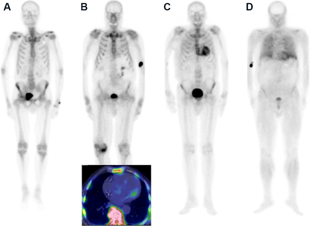 clinical-application-of-cardiac-scintigraphy-with-bone-tracers