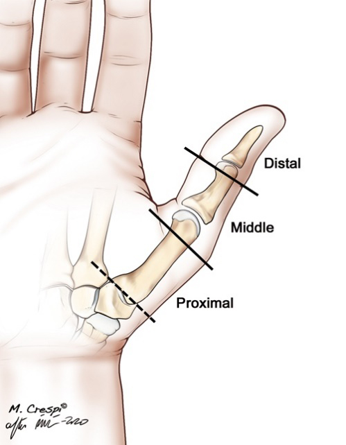 Braun has second procedure on his thumb