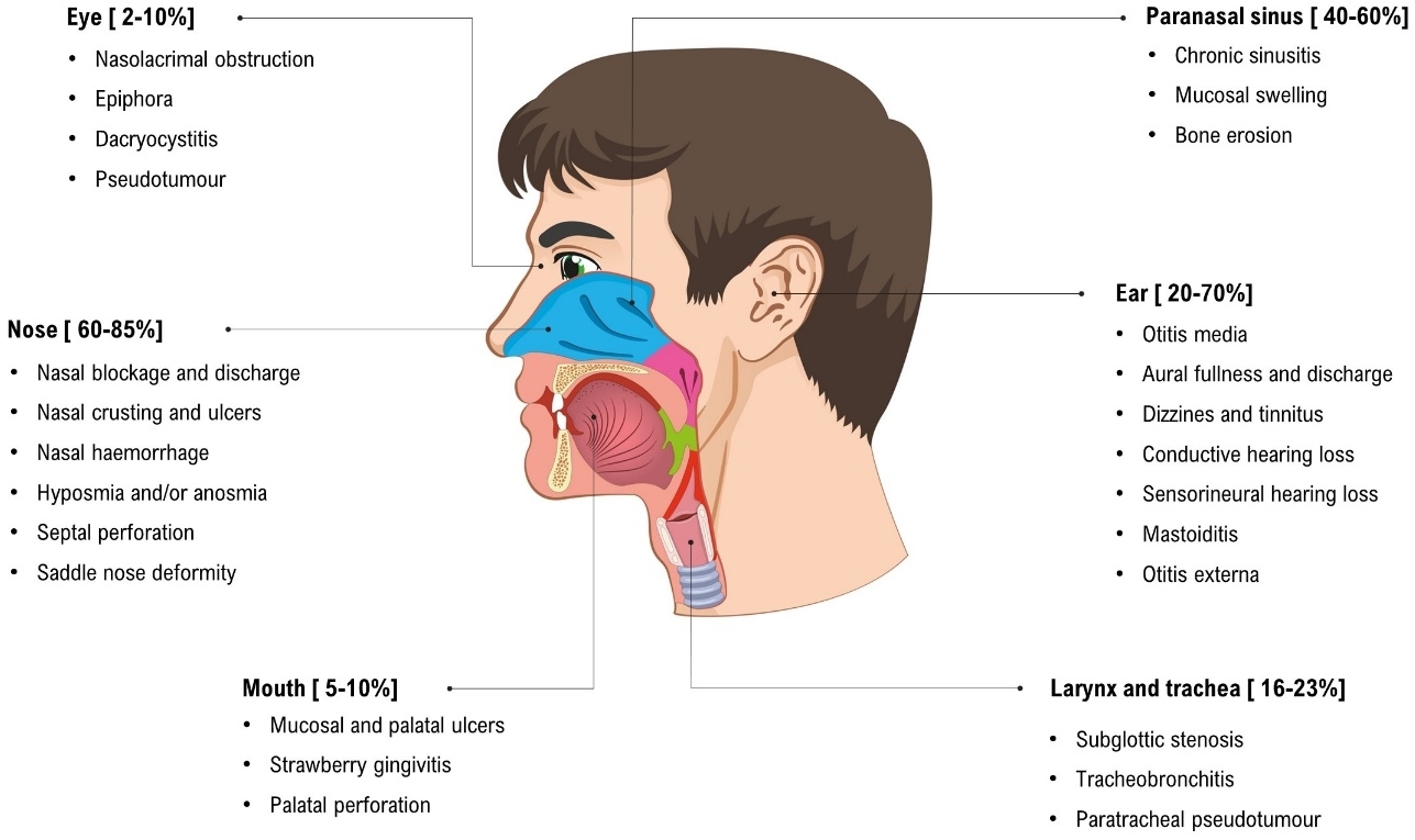 purulent nasal drainage