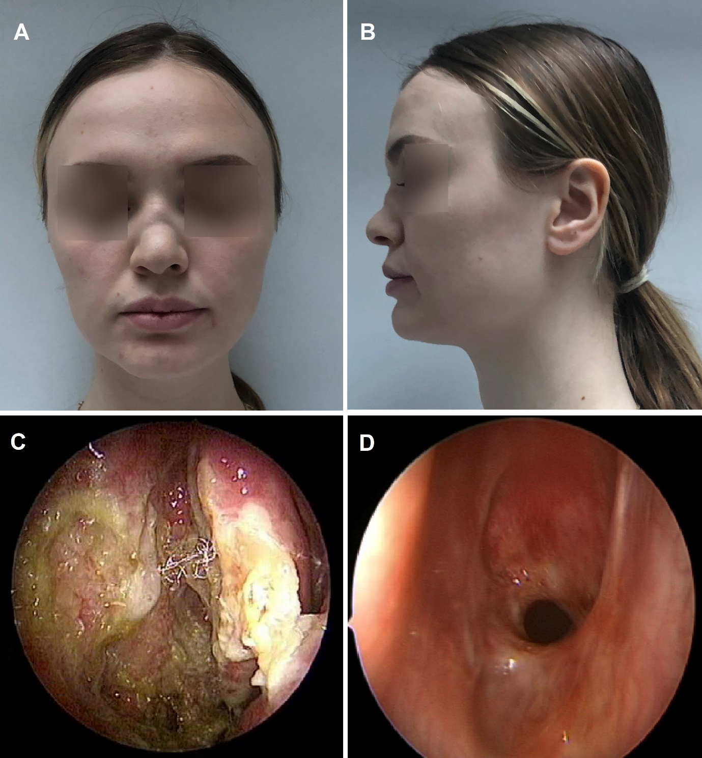 purulent nasal drainage