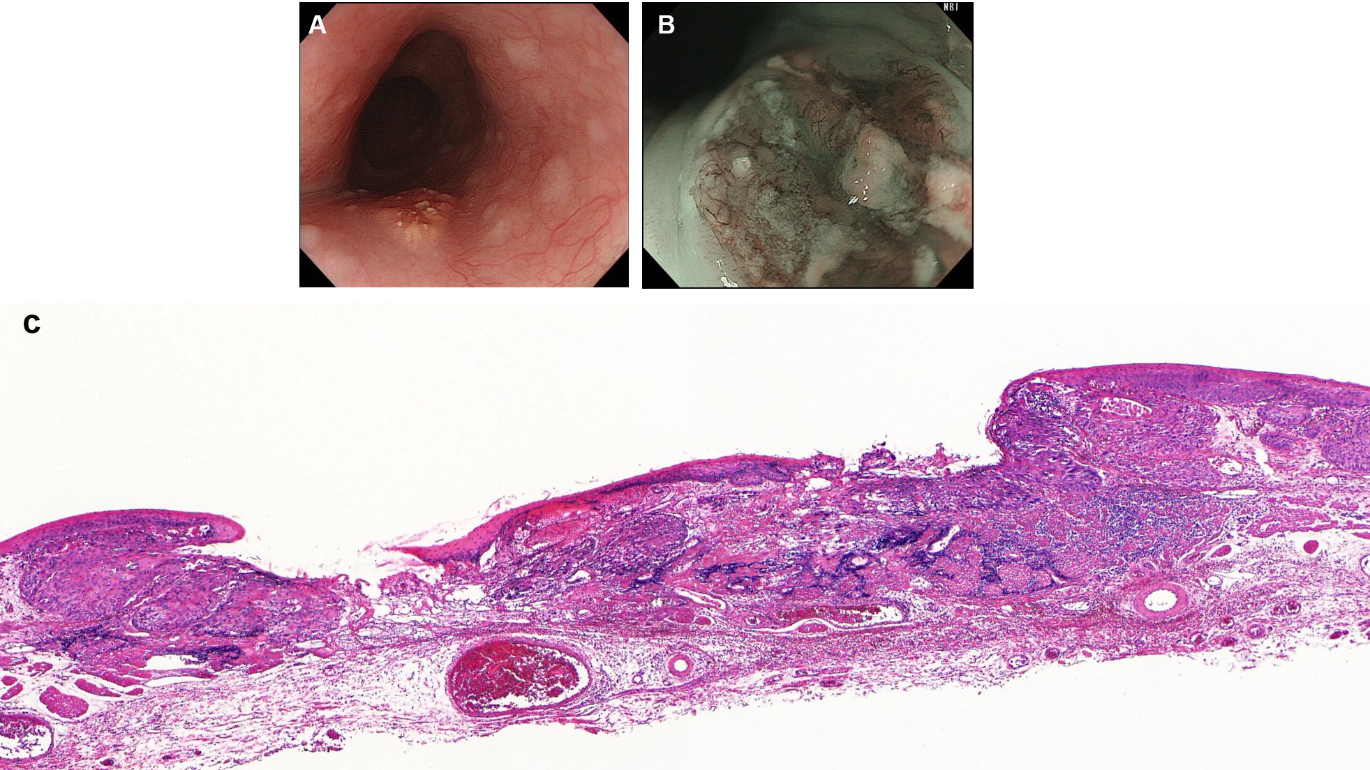 Indications Of Esophageal Cancer For Endoscopic Submucosal Dissection ...