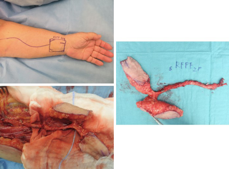 The use of free chimeric flaps in head and neck reconstruction: technical pearls and clinical applications