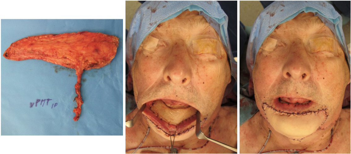 The use of free chimeric flaps in head and neck reconstruction: technical pearls and clinical applications