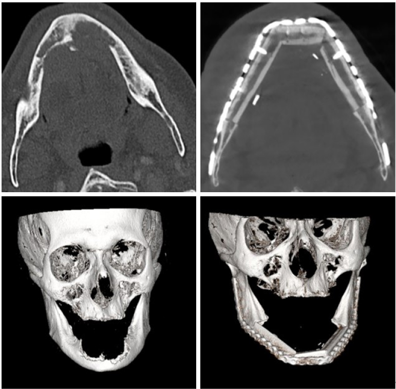 The use of free chimeric flaps in head and neck reconstruction: technical pearls and clinical applications