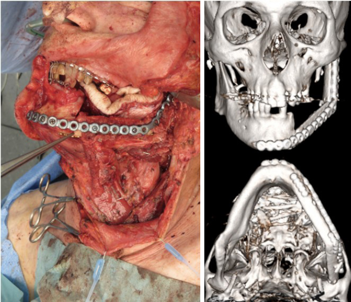The use of free chimeric flaps in head and neck reconstruction: technical pearls and clinical applications