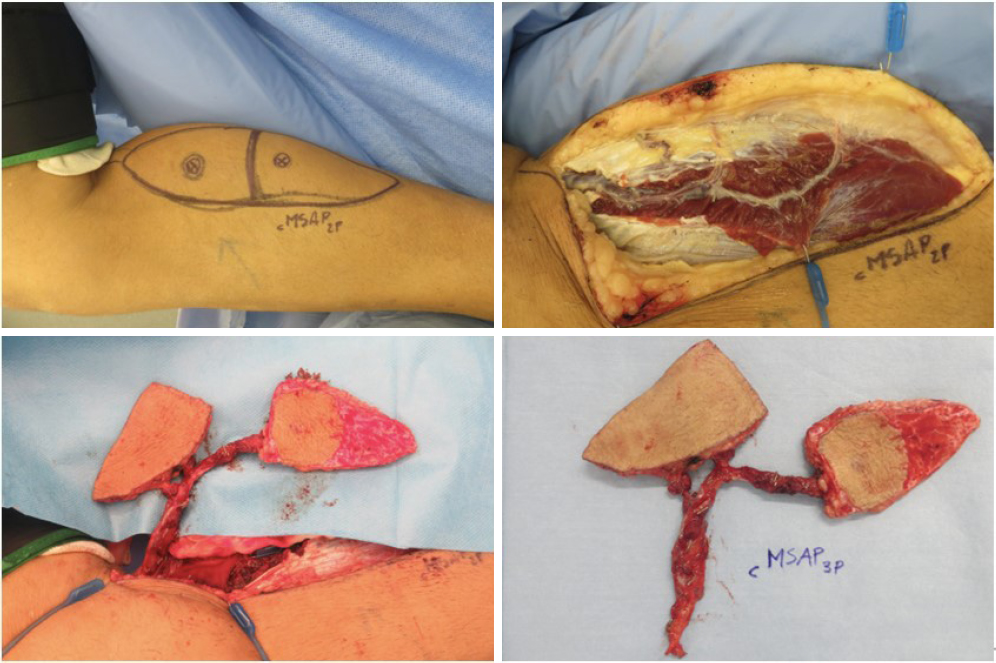 The use of free chimeric flaps in head and neck reconstruction: technical pearls and clinical applications