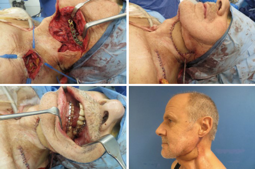 The use of free chimeric flaps in head and neck reconstruction: technical pearls and clinical applications