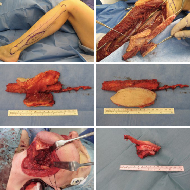 The use of free chimeric flaps in head and neck reconstruction: technical pearls and clinical applications