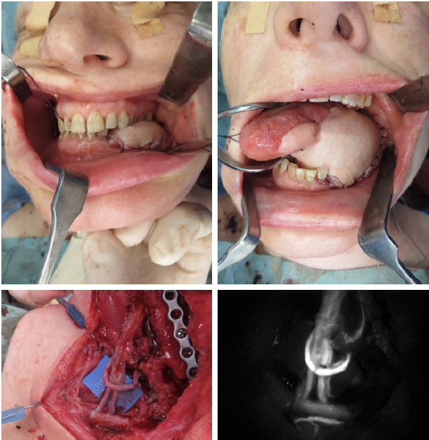 The use of free chimeric flaps in head and neck reconstruction: technical pearls and clinical applications