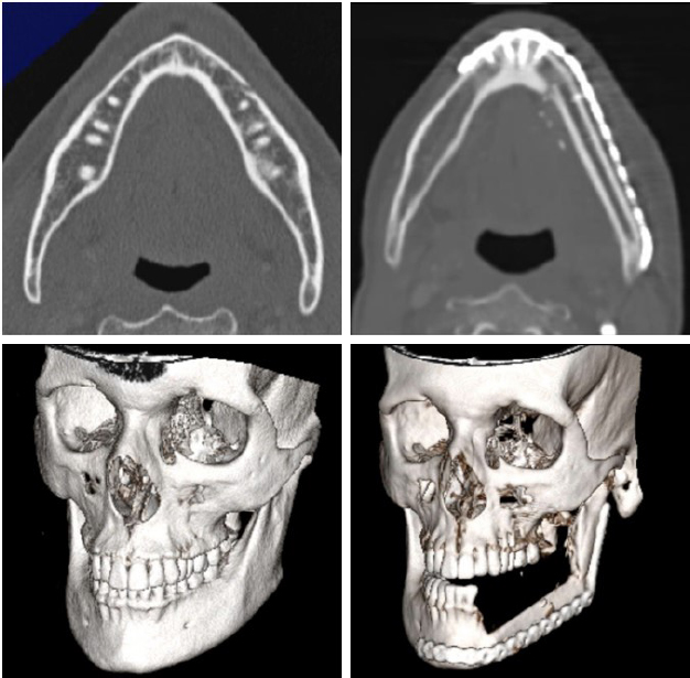 The use of free chimeric flaps in head and neck reconstruction: technical pearls and clinical applications