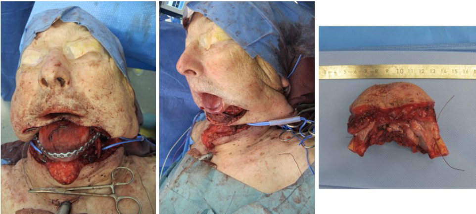 The use of free chimeric flaps in head and neck reconstruction: technical pearls and clinical applications