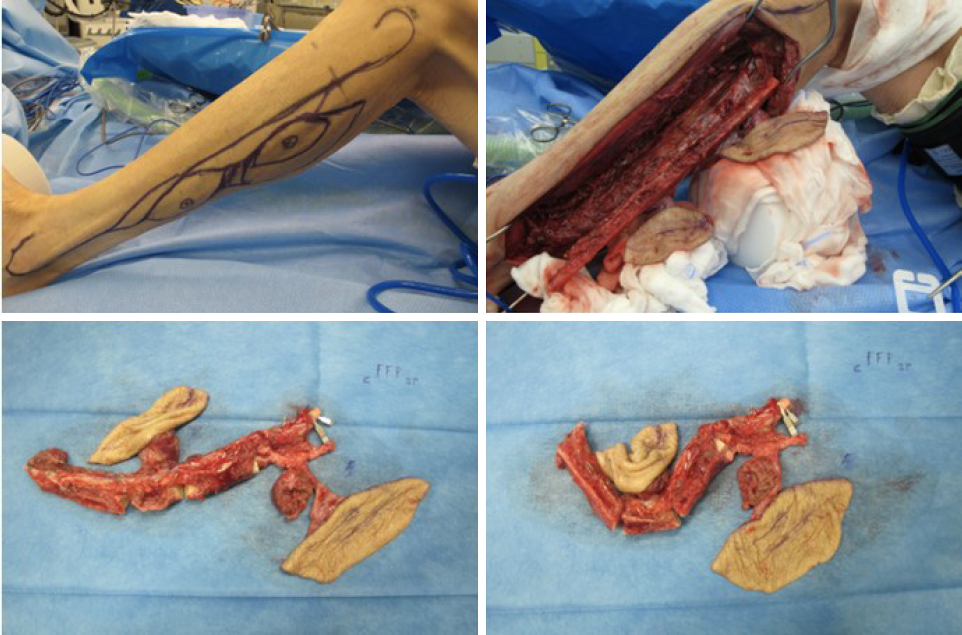 The use of free chimeric flaps in head and neck reconstruction: technical pearls and clinical applications
