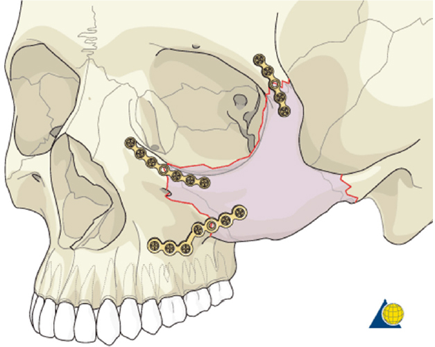 zygomatic arch fracture treatment