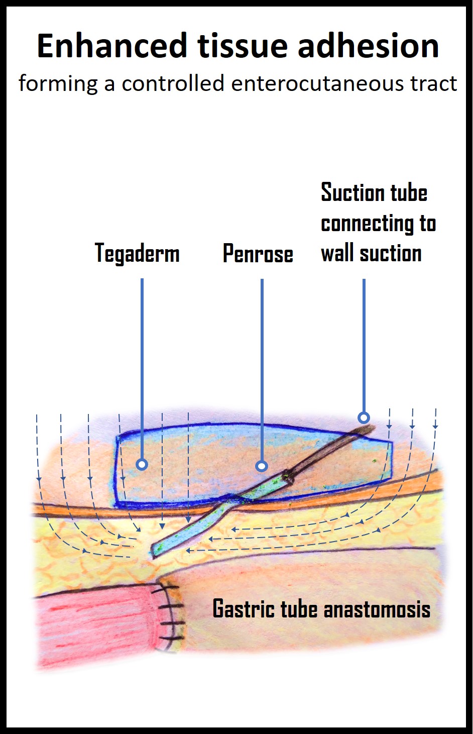 Healing the gap: the evolution of esophageal substitute and quality of ...