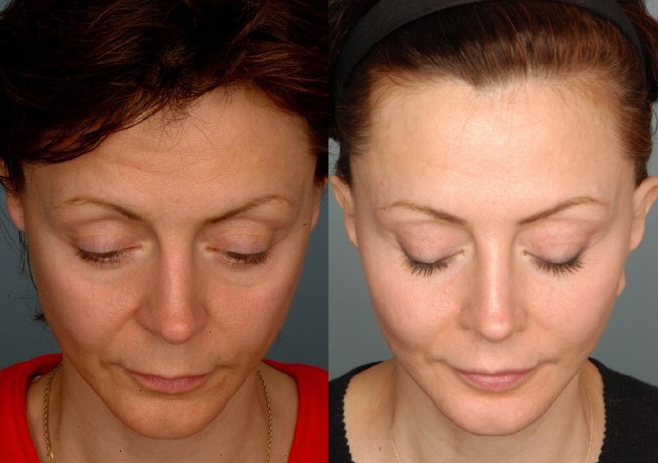 Endoscopic Assisted Facial Rejuvenation A 35 Year Personal Journey