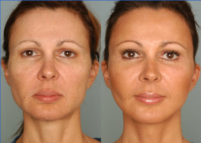 Endoscopic Assisted Facial Rejuvenation A 35 Year Personal Journey