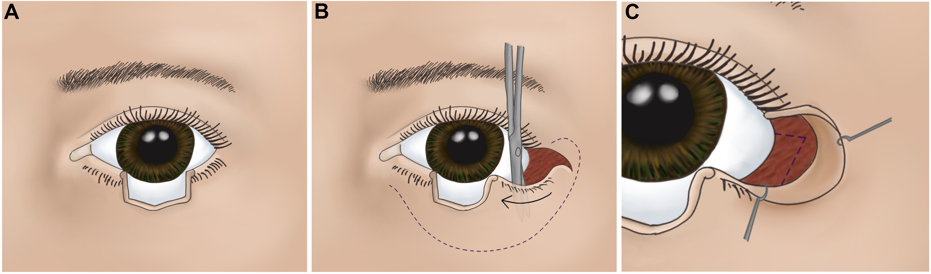 Eyelid Defect Reconstruction 2757