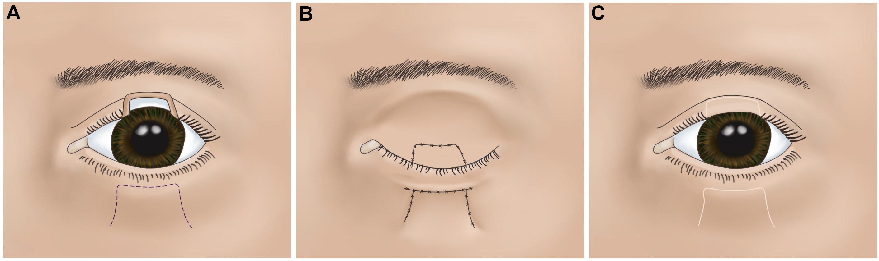Eyelid defect reconstruction