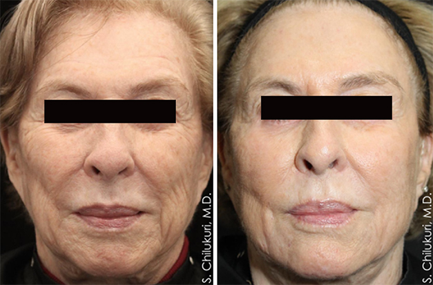 The Benefit Of Combined Radiofrequency And Ultrasound To Enhance Surgical And Nonsurgical Outcomes For The Face And Neck