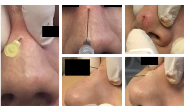 Scar post Bio Alcamide filler used on the leg (a) before (b) after