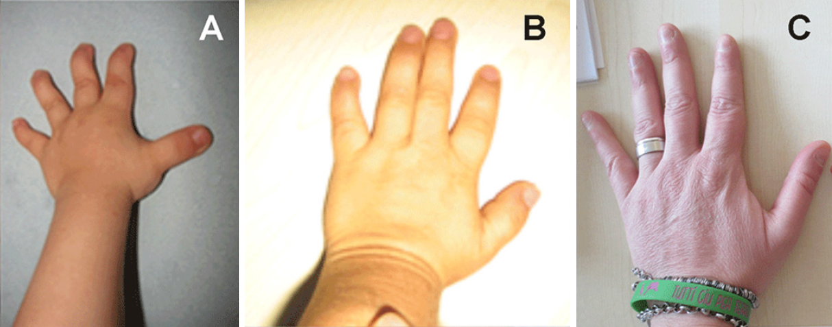 Disorders crease genetic single palmar [A phenotypic