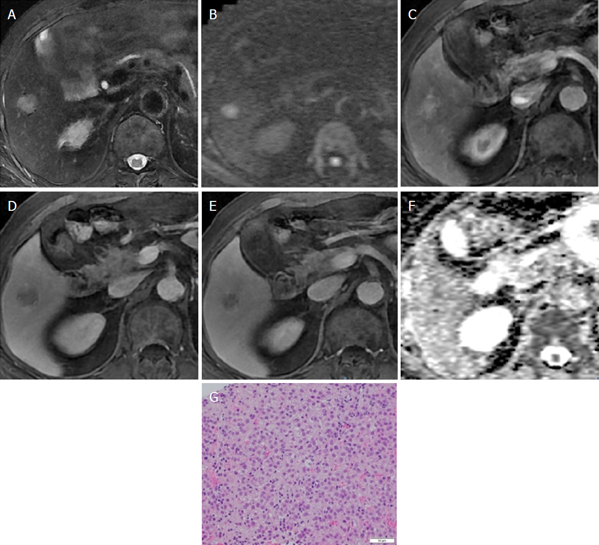 Distinctive resonance imaging findings of hepatocellular