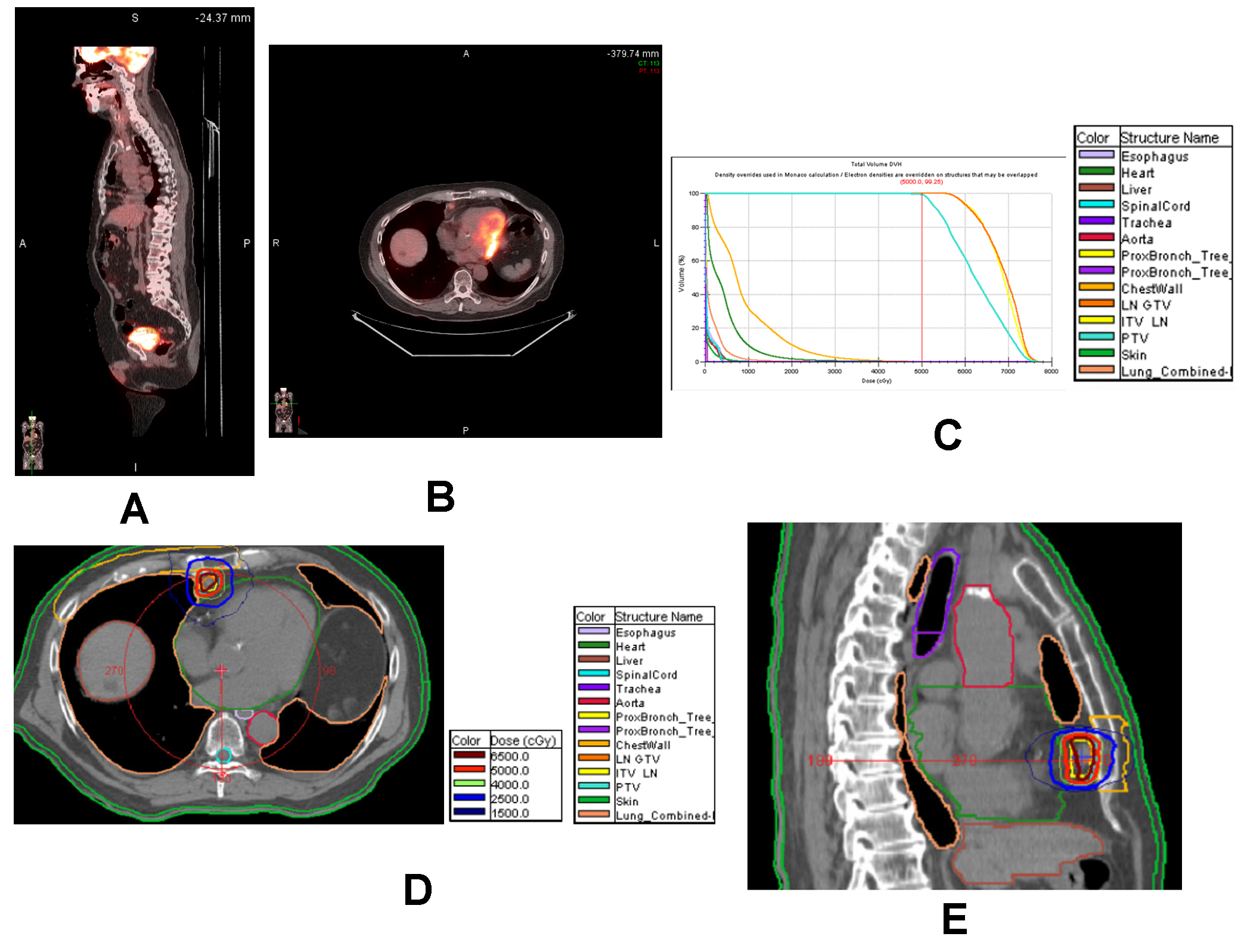 The role of radiation therapy in the management of primary thymic epithelial neoplasms