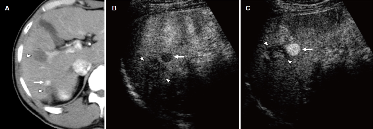 Contrast Enhanced Ultrasonography With Sonazoid In Hepatocellular Carcinoma Diagnosis