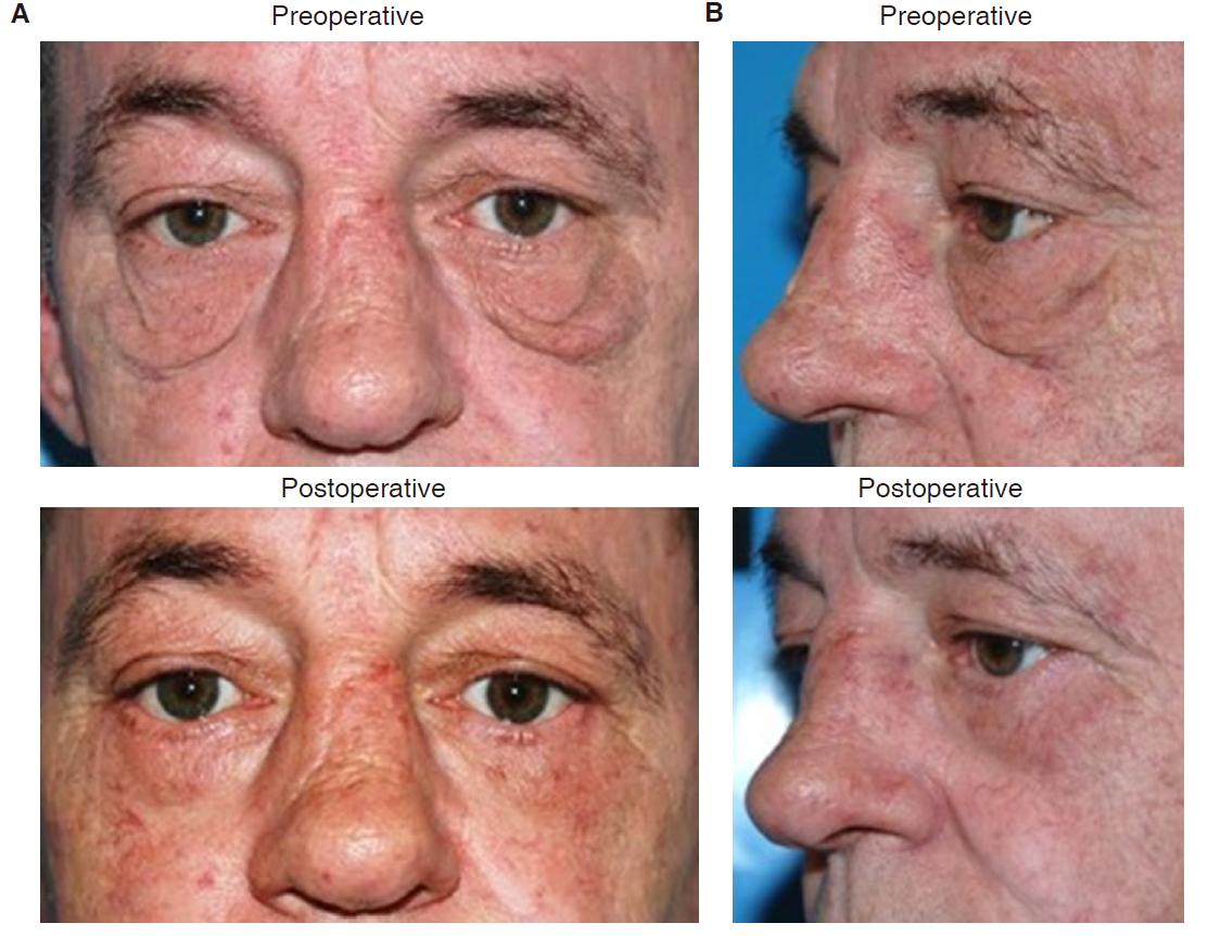 Modified Lower Eyelid Blepharoplasty Improves Aesthetic Outcomes