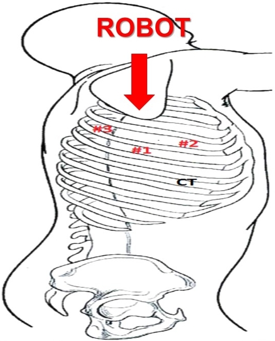 Technique Of Robotic First Rib Resection For Thoracic Outlet Syndrome