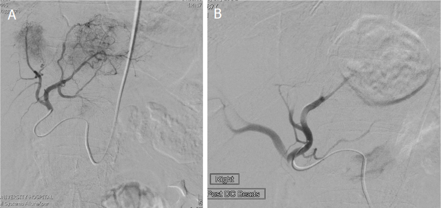 Technical Update On Transcatheter Arterial Chemoembolization