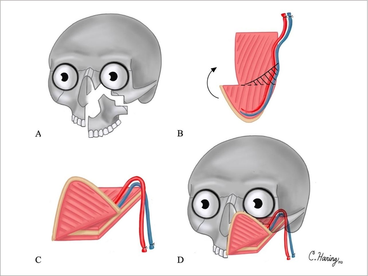 Osteotomized Folded Scapular Tip Free Flap For Complex Midfacial ...