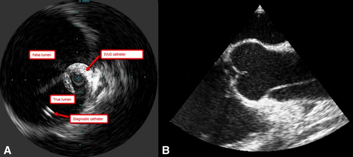 Management Of Chronic Type B Aortic Dissection