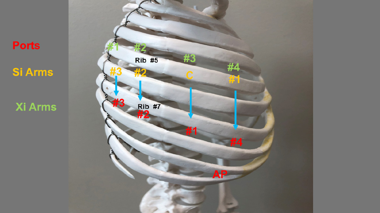 The technique of robotic anatomic pulmonary segmentectomy I right