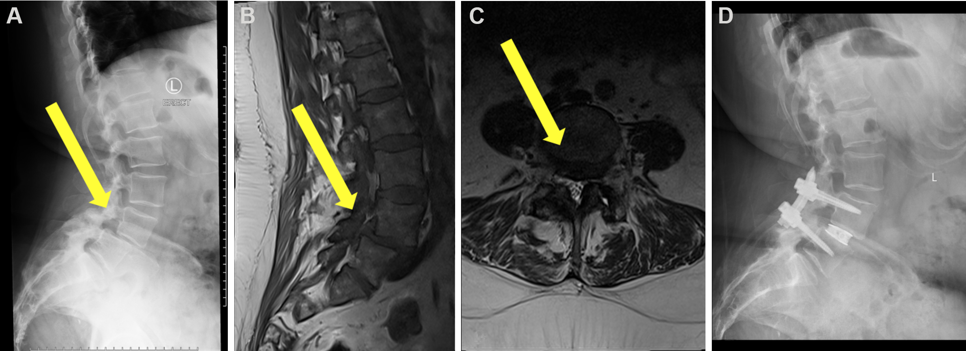 Single Position Lateral Lumbar Interbody Fusion And Pedicle Screw