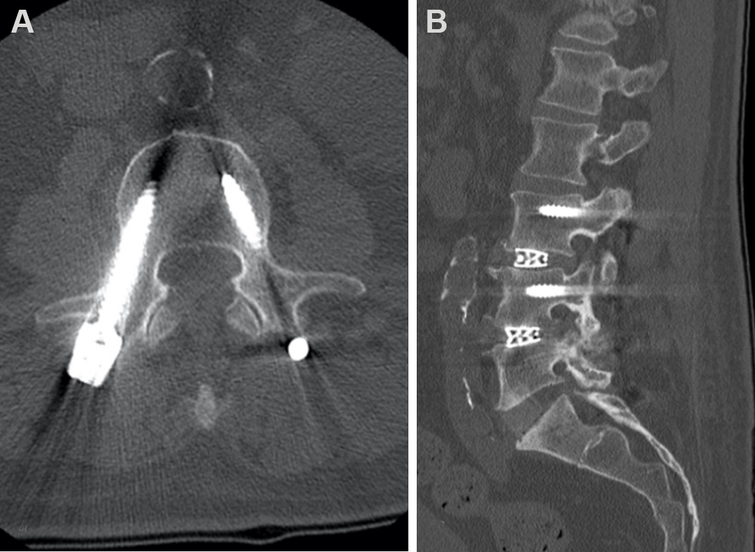 Single position lateral lumbar interbody fusion and pedicle screw ...