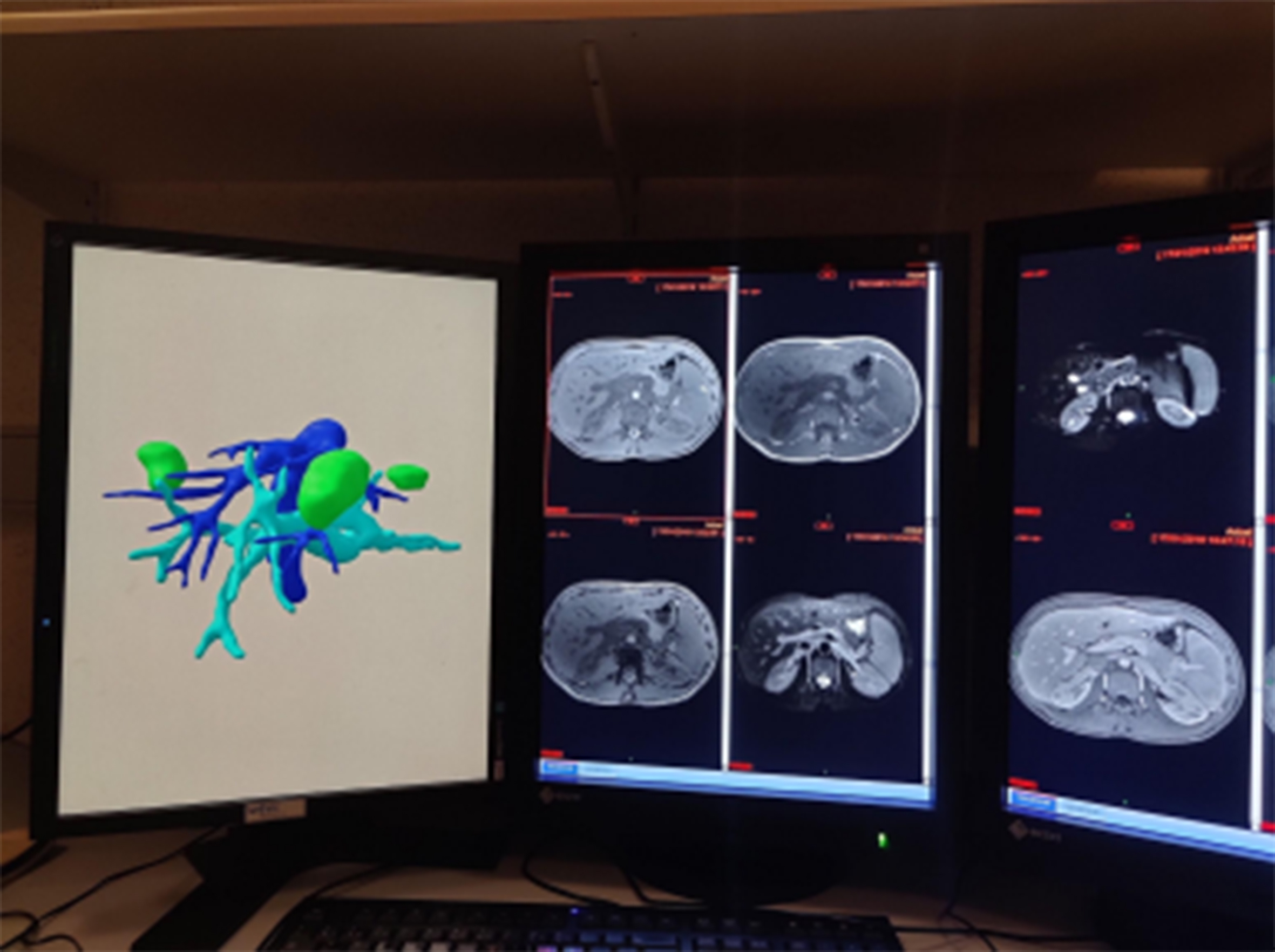 Contribution of 3D virtual modeling in locating hepatic metastases, particularly “vanishing tumors”: a pilot study