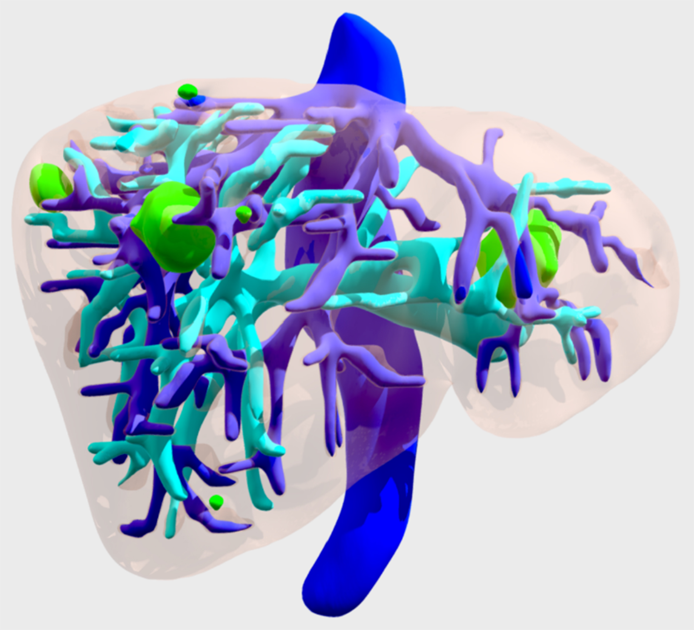 Contribution of 3D virtual modeling in locating hepatic metastases, particularly “vanishing tumors”: a pilot study