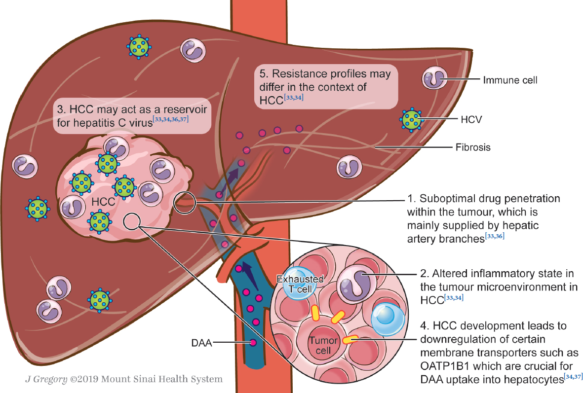 Management Of Concomitant Hepatocellular Carcinoma And Chronic Hepatitis C A Review