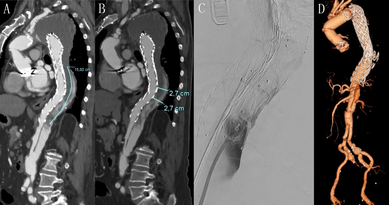 New Endovascular Techniques For False Lumen Thrombosis In Aortic Dissection After Thoracic