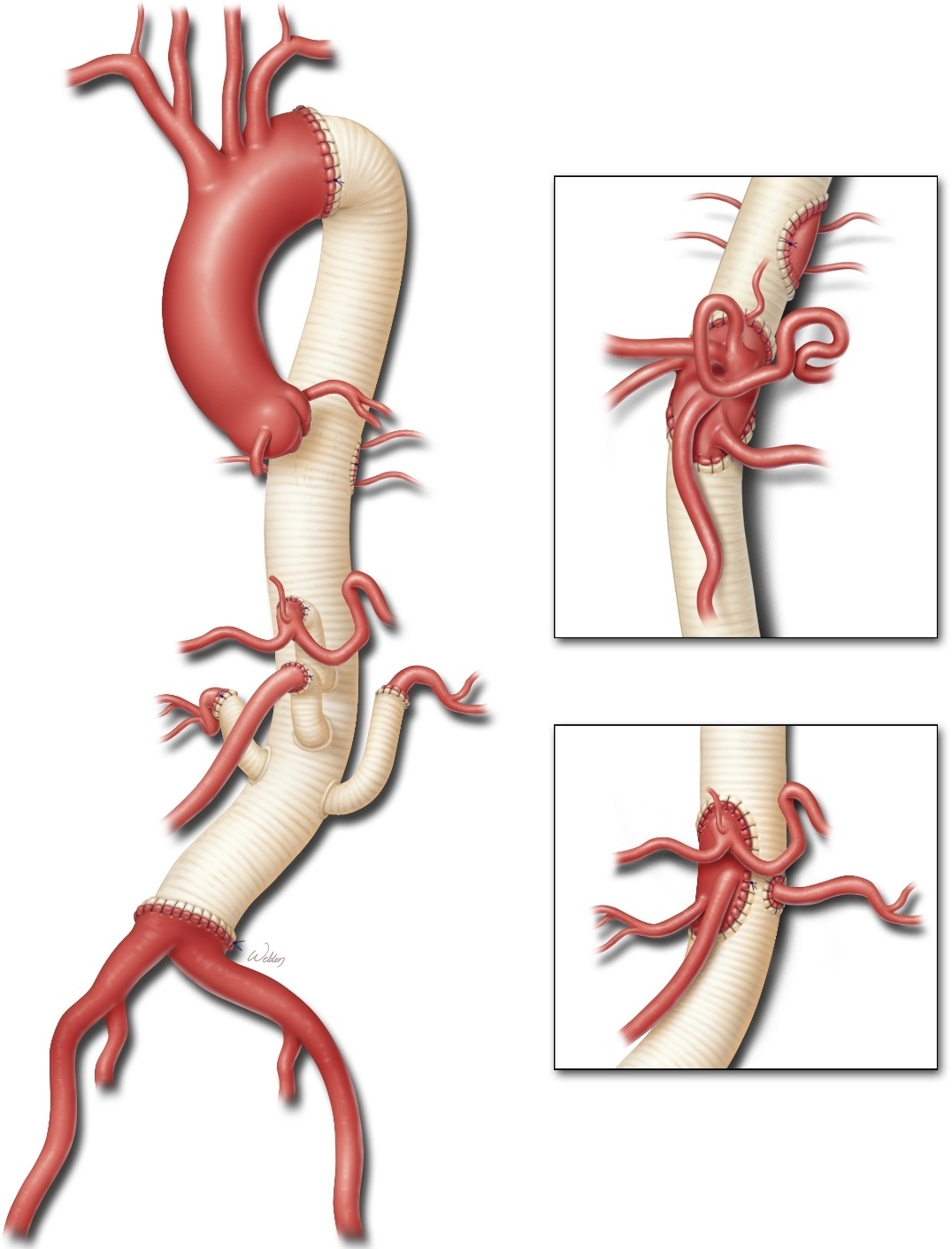 Open repair for thoracoabdominal aortic aneurysms precipitated by ...