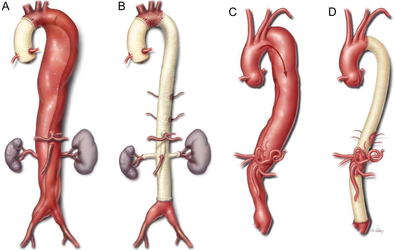 Open Repair For Thoracoabdominal Aortic Aneurysms Precipitated By