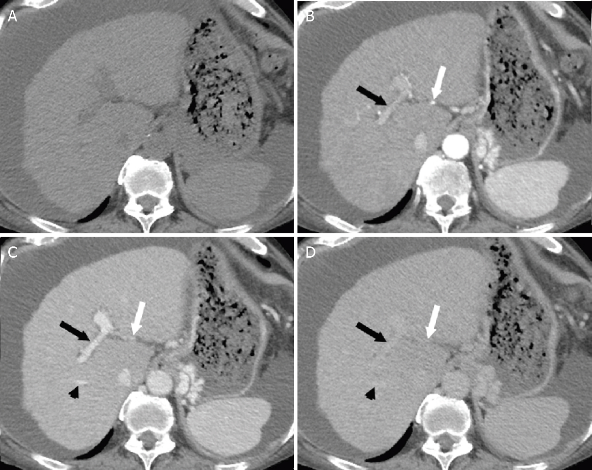 Ct And Mri Of The Liver For Hepatocellular Carcinoma